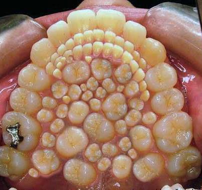 Hyperdontia - too many teeth